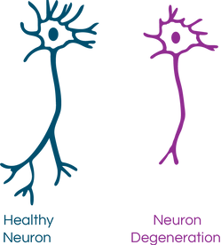 Comparison of a healthy neuron to neuron degeneration
