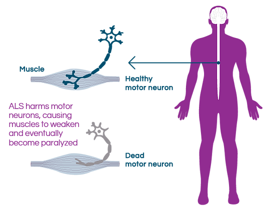 Healthy motor neuron and muscle compared to dead motor neuron. ALS harms motor neurons, causing muscles to weaken and eventually become paralyzed.